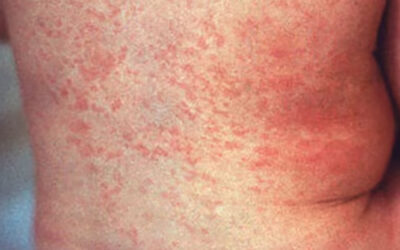 County Finds First 2026 Measles Case