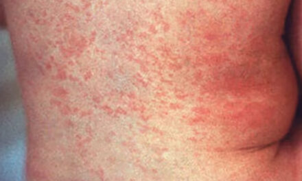 County Finds First 2026 Measles Case 